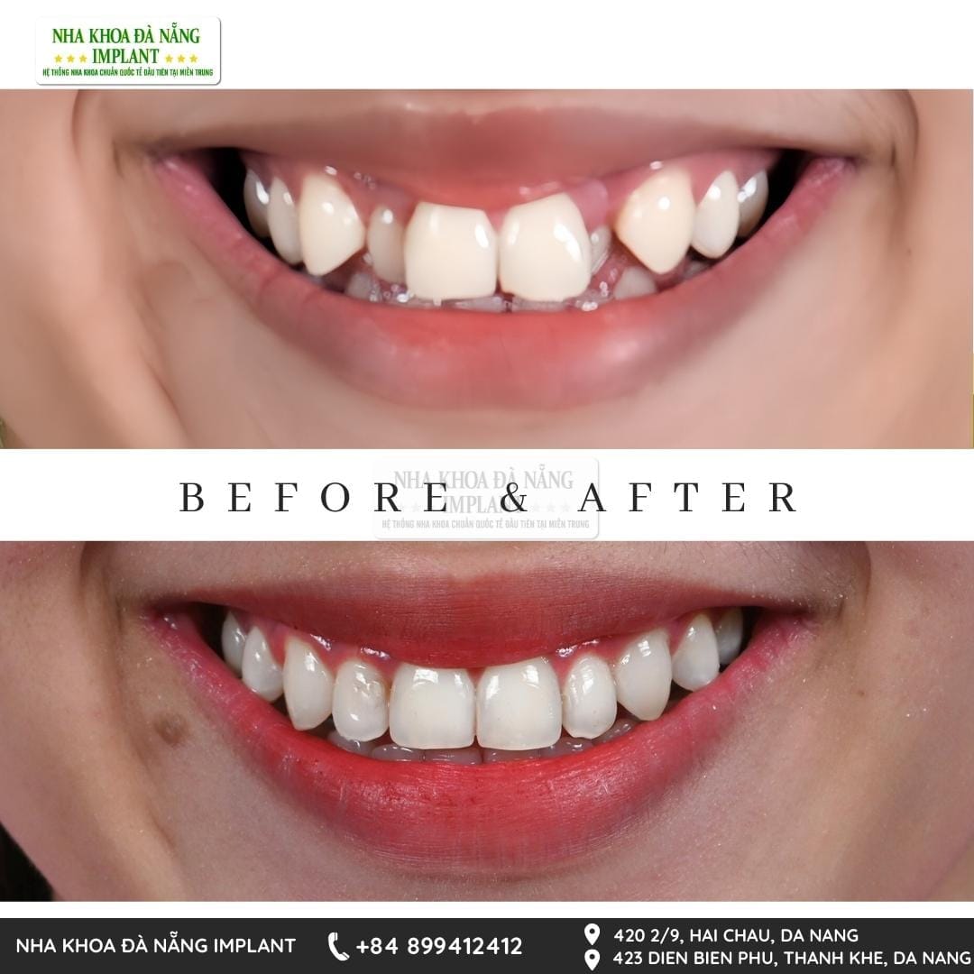 Failed Orthodontic Treatment and Warning Signs – Alerts and Solutions from Da Nang Implant Dental Clinic