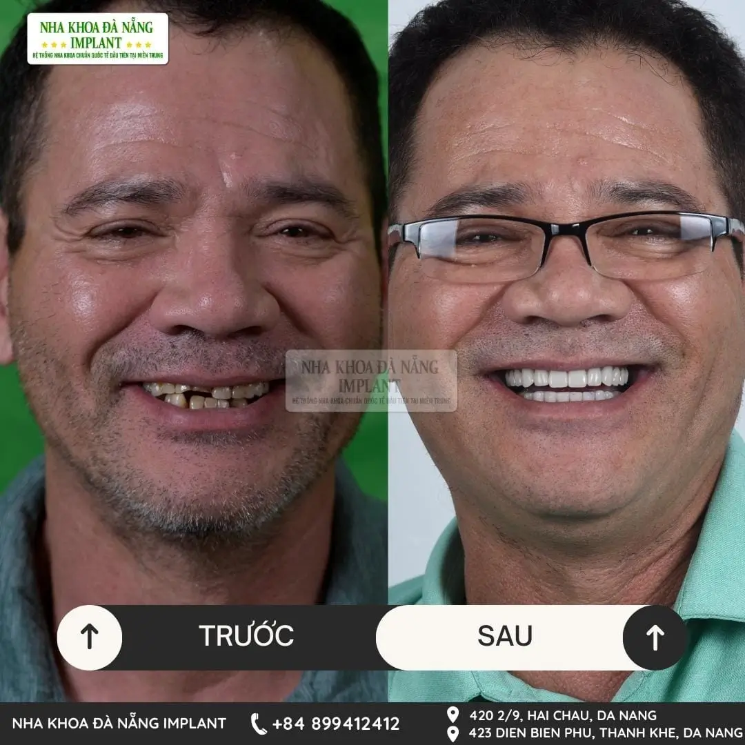 Trồng răng Implant chuẩn quốc tế – Tiết kiệm đến 70% chi phí cho Việt kiều tại Nha Khoa Đà Nẵng Implant 16 Khách hàng Dương Bình