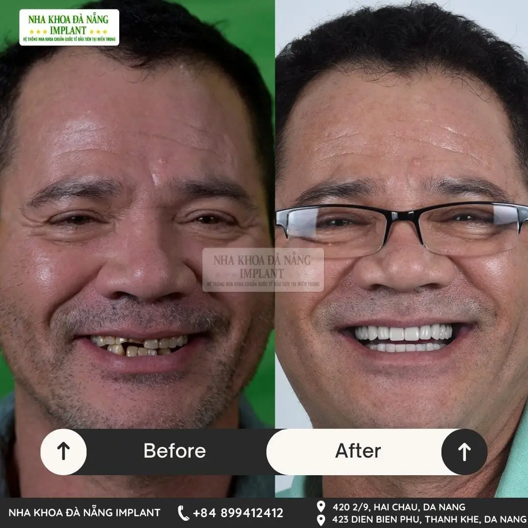 International standard dental implant – Save up to 70% of costs for overseas Vietnamese at Da Nang Implant Dental Clinic 16 Customer Duong Binh