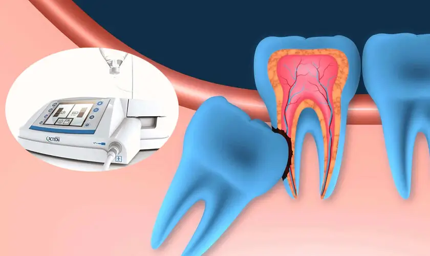 Nhổ răng bằng công nghệ hiện đại