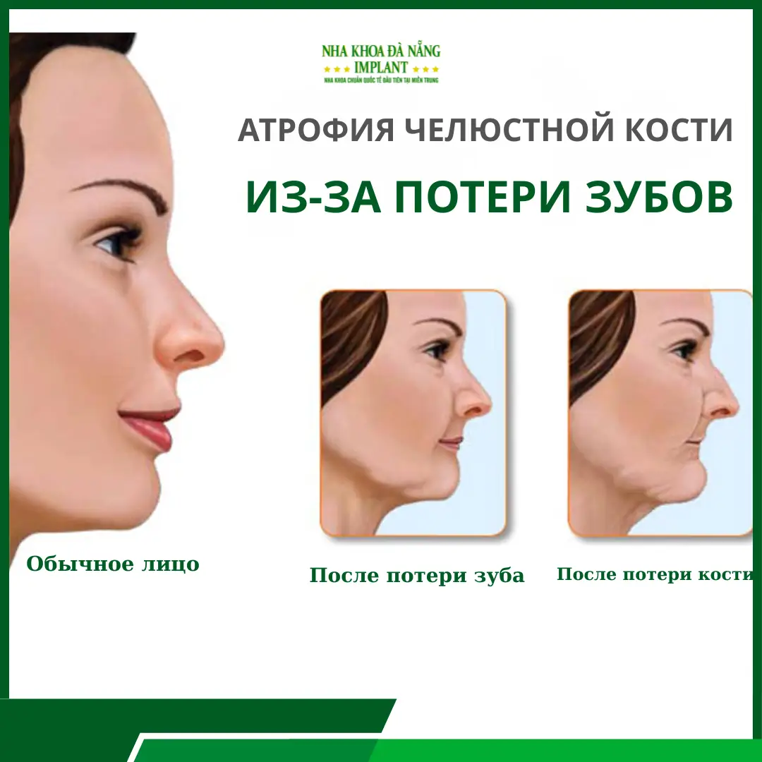 Последствия длительной потери зубов