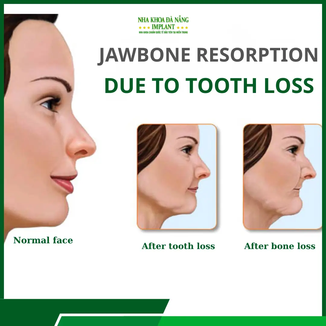 Consequences of long-term tooth loss
