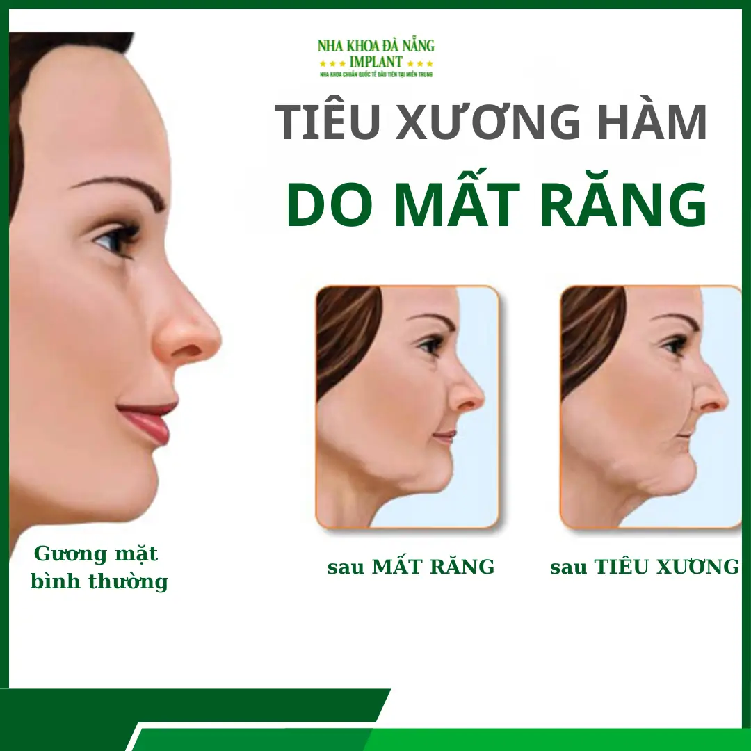 Hậu quả của việc mất răng lâu năm