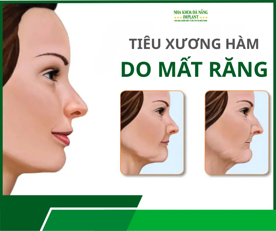 Bác sĩ Phan Văn Cường chia sẻ 10+ năm kinh nghiệm điều trị các ca cấy ghép Implant phức tạp