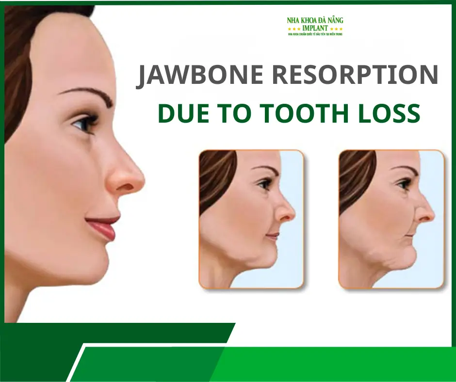 Dr. Phan Van Cuong shares over 10 years of experience in treating complex dental implant cases