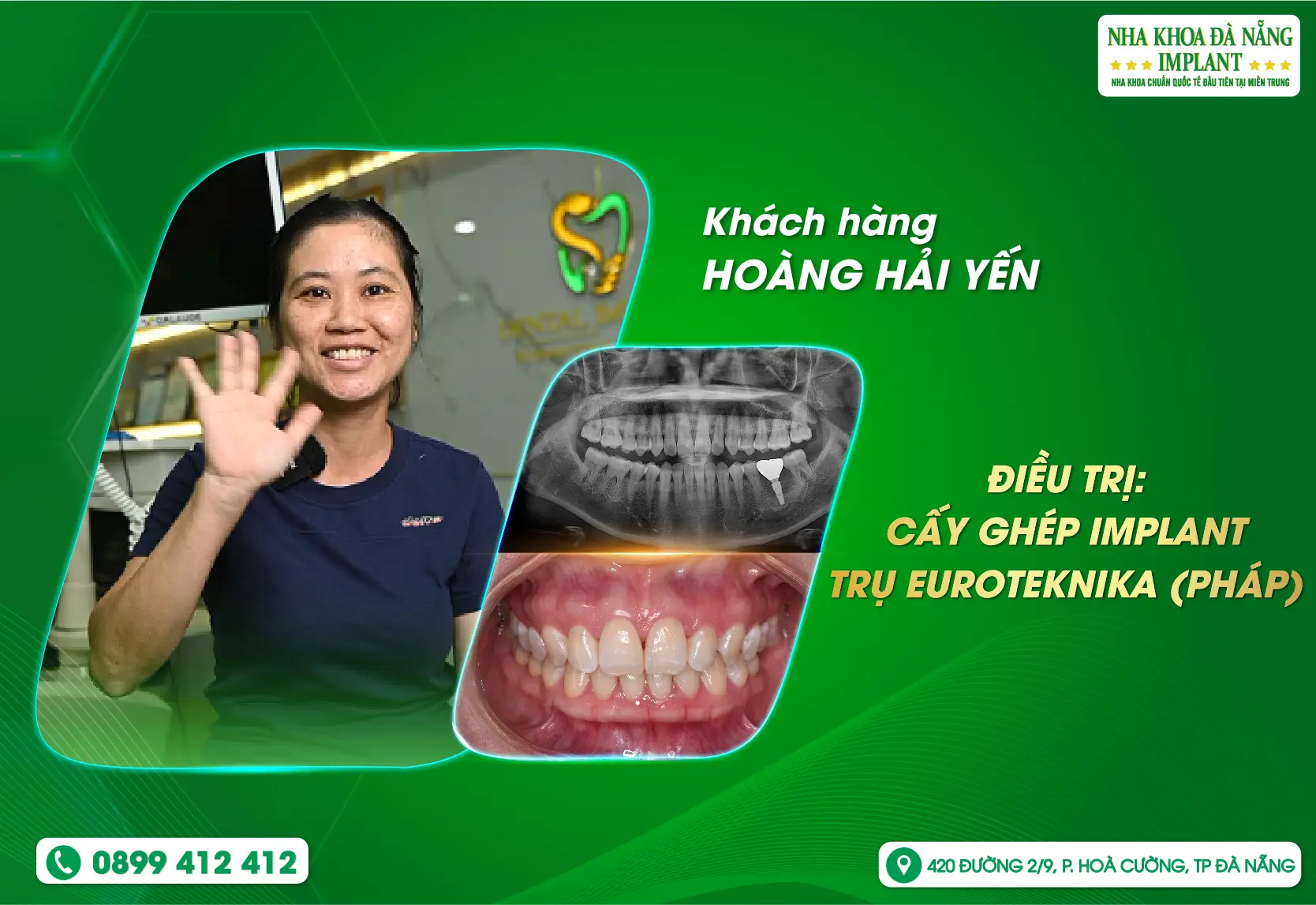 Bí quyết khôi phục ăn nhai và nụ cười khoẻ mạnh