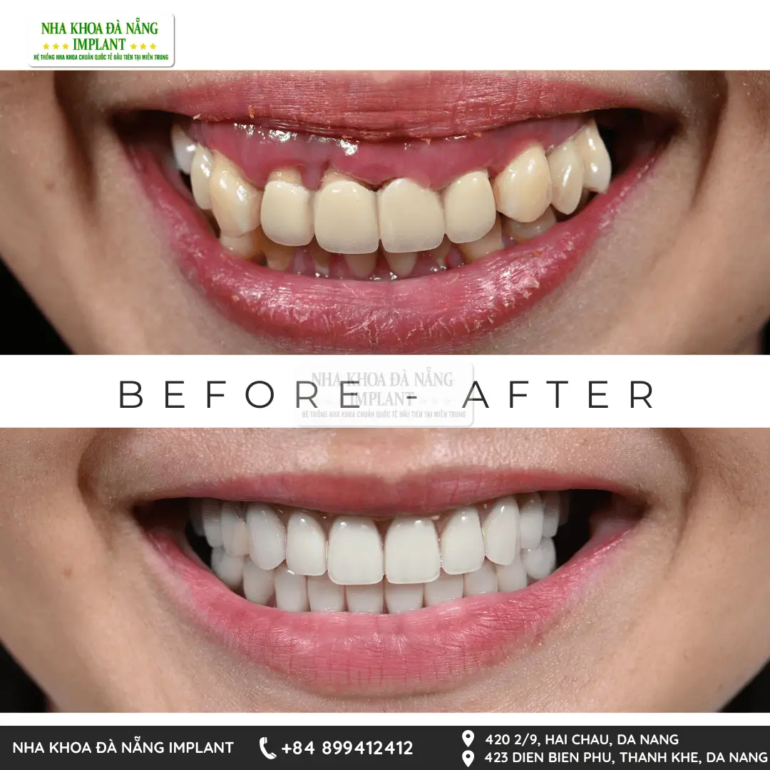 Dr. Phan Van Cuong shares over 10 years of experience in treating complex dental implant cases