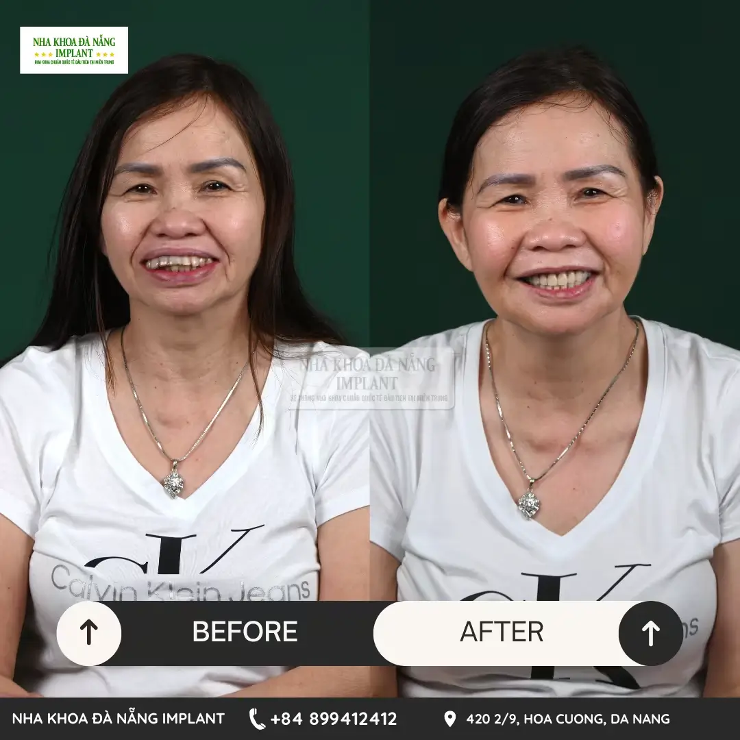 International standard dental implant – Save up to 70% of costs for overseas Vietnamese at Da Nang Implant Dental Clinic 14 Customer Huynh Thi An
