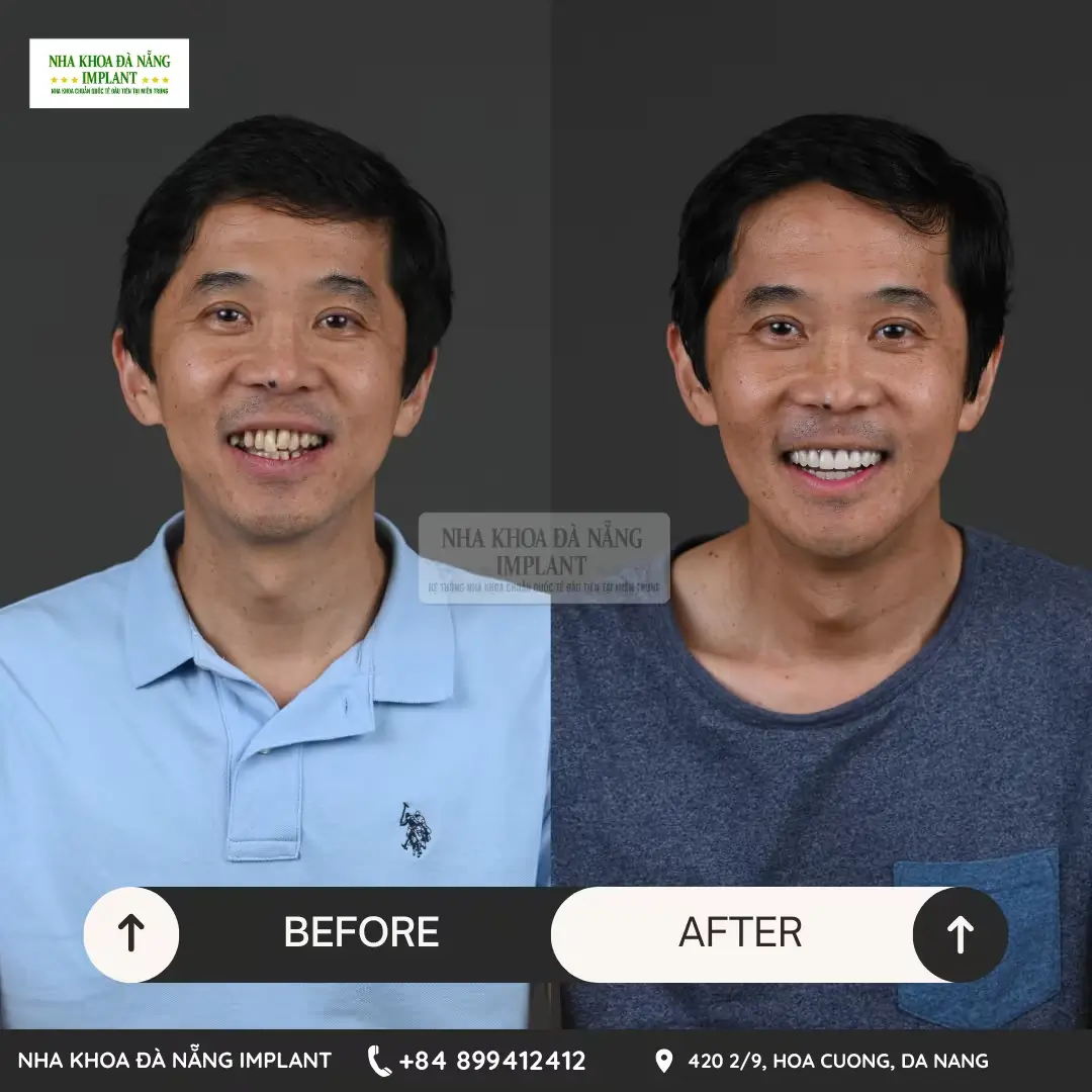 International standard dental implant – Save up to 70% of costs for overseas Vietnamese at Da Nang Implant Dental Clinic 15 Customer Le Hung Viet