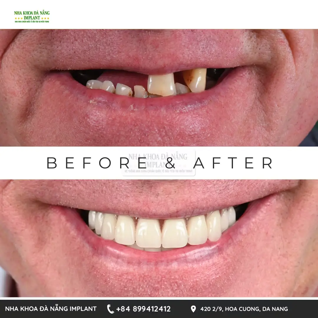 Dr. Phan Van Cuong shares over 10 years of experience in treating complex dental implant cases