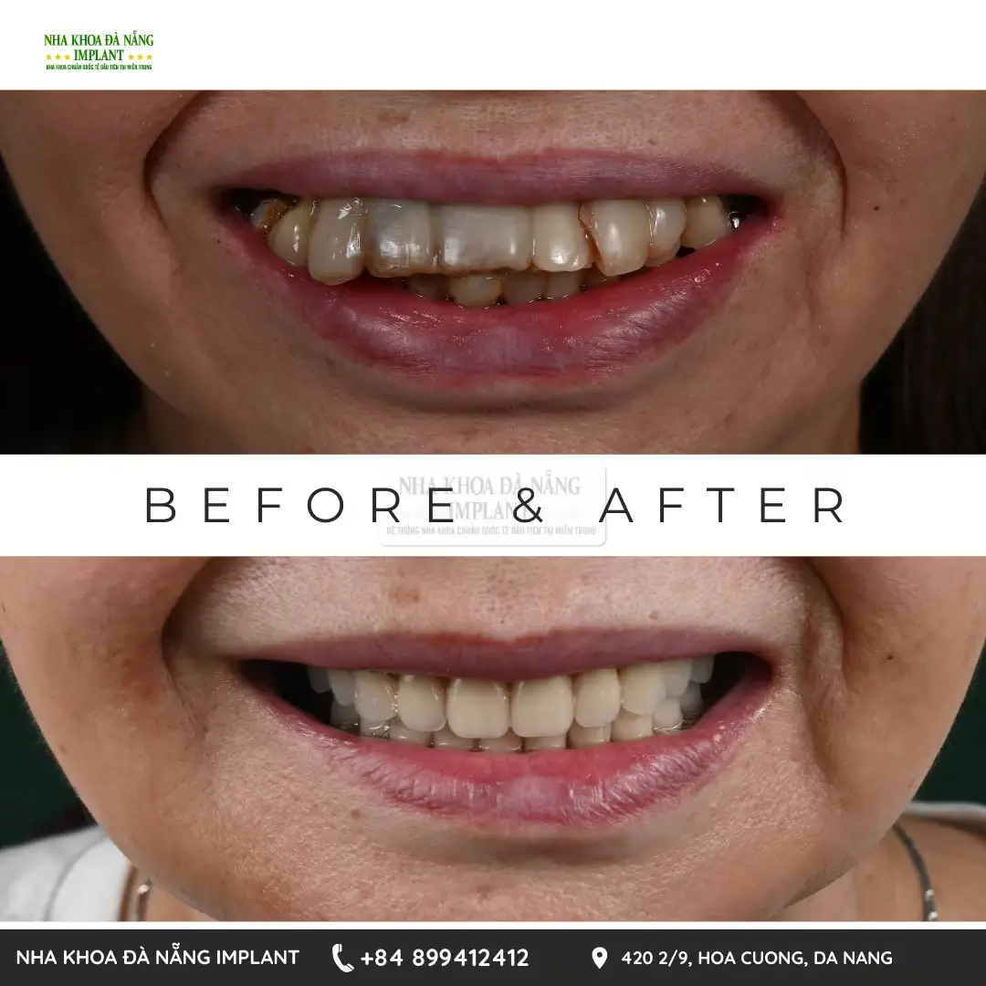 Dr. Phan Van Cuong shares over 10 years of experience in treating complex dental implant cases
