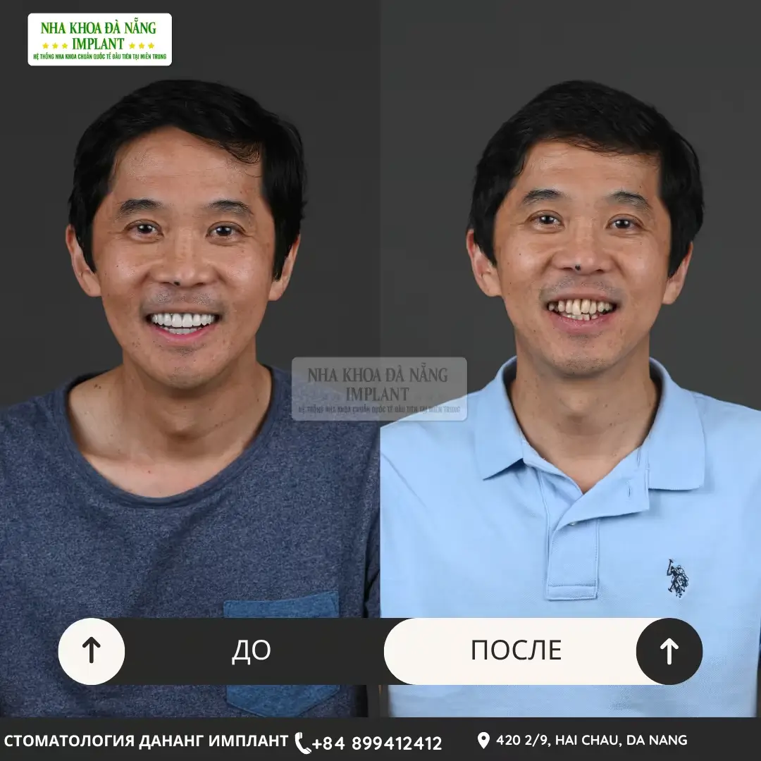 Имплантация зубов – до 70% экономии для вьетнамцев за границей 15 Клиент Le Hung Viet