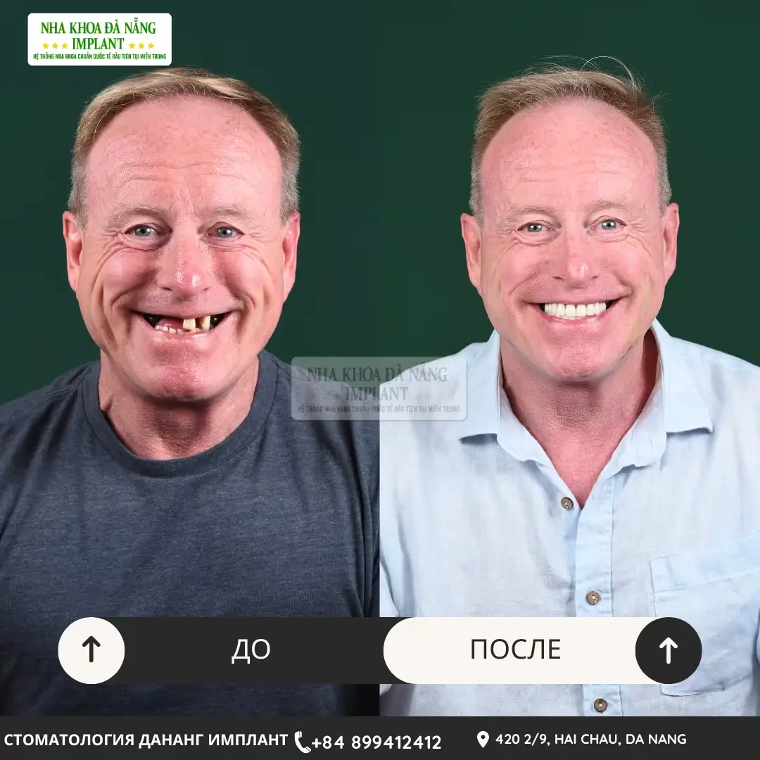 Болезненно ли устанавливать имплантаты? Врач развенчивает 5 распространённых заблуждений об имплантации 14 Дентальная имплантация в клинике Da Nang Implant Dental Clinic