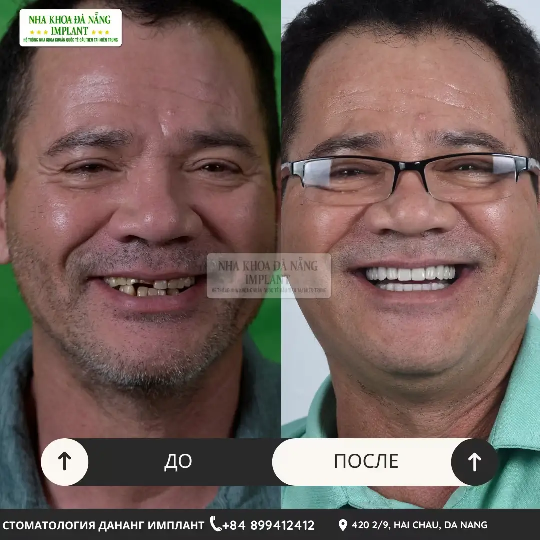 Имплантация зубов – до 70% экономии для вьетнамцев за границей 16 Клиент Duong Binh