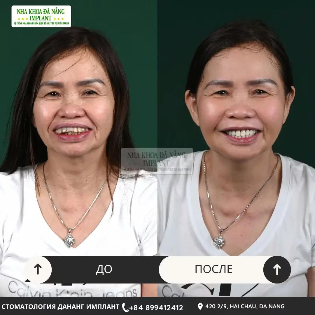 Имплантация зубов – до 70% экономии для вьетнамцев за границей 14 Клиент Huynh Thi An