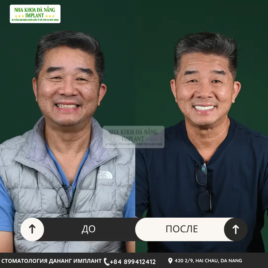 Имплантация зубов – до 70% экономии для вьетнамцев за границей 13 Клиент Larry Nguyễn