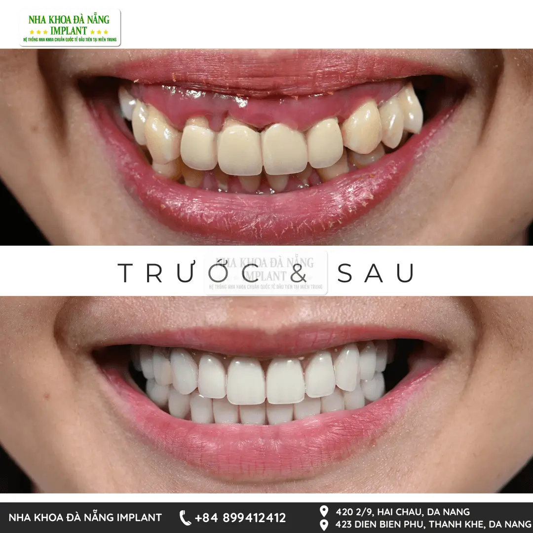 Bác sĩ Phan Văn Cường chia sẻ 10+ năm kinh nghiệm điều trị các ca cấy ghép Implant phức tạp
