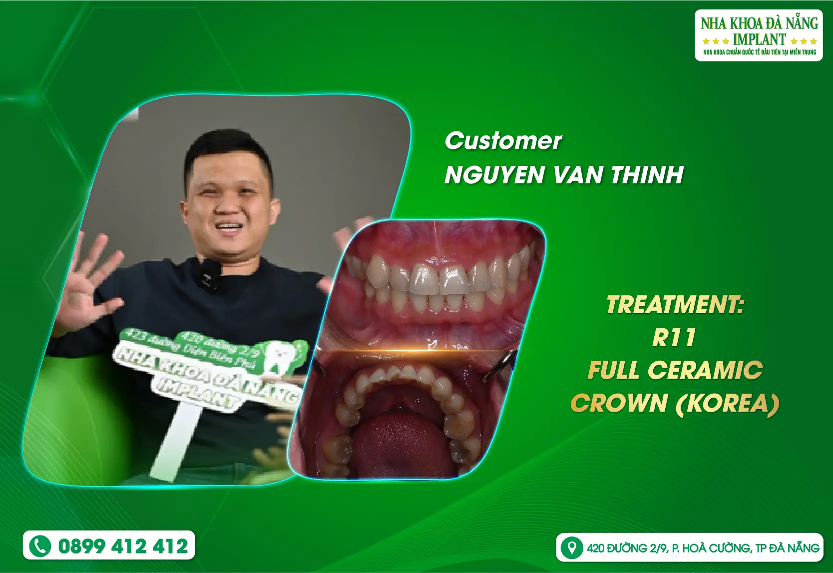 Regain your confident smile after just 2 appointments.