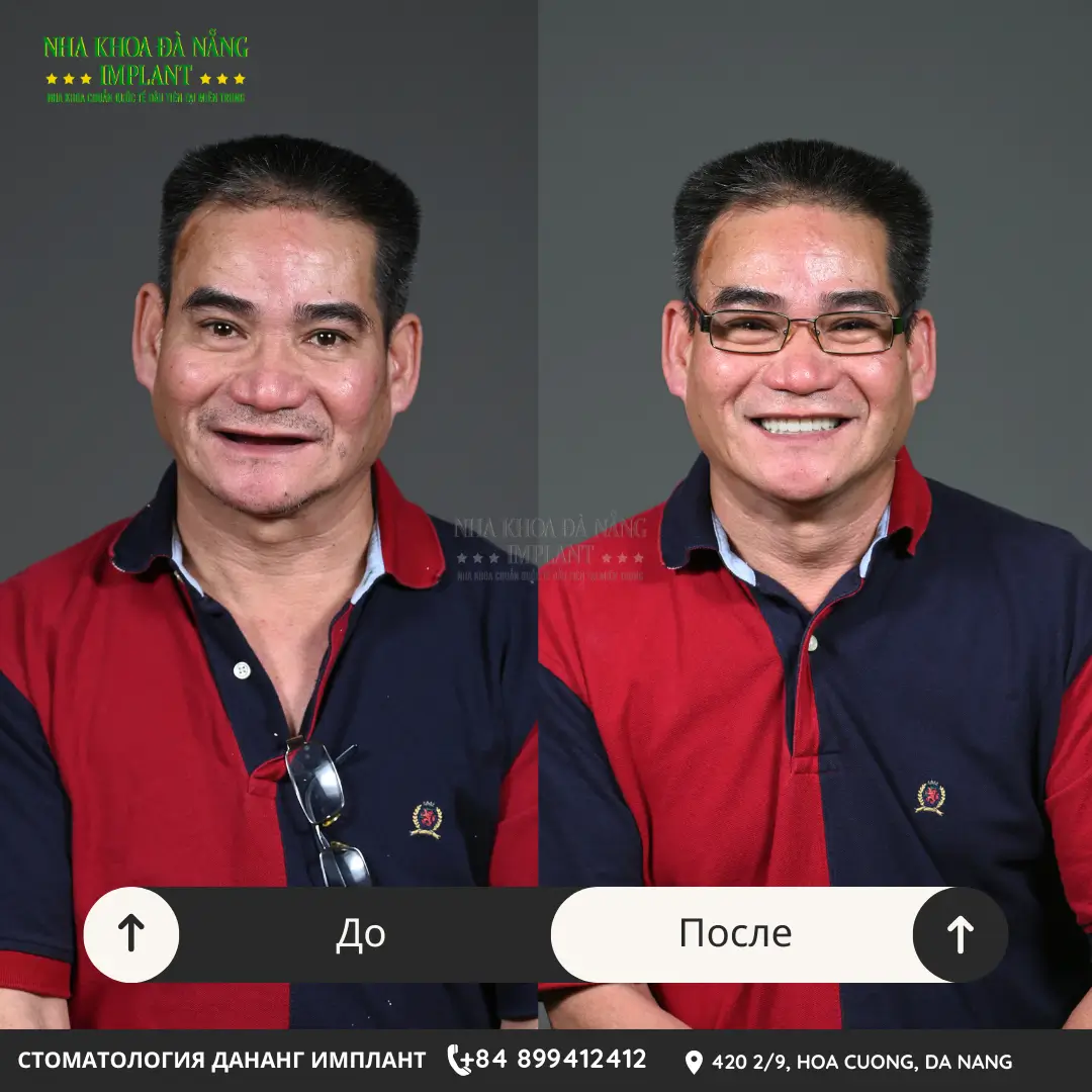 Сколько служат съёмные протезы? Прайс-лист и советы по продлению срока службы