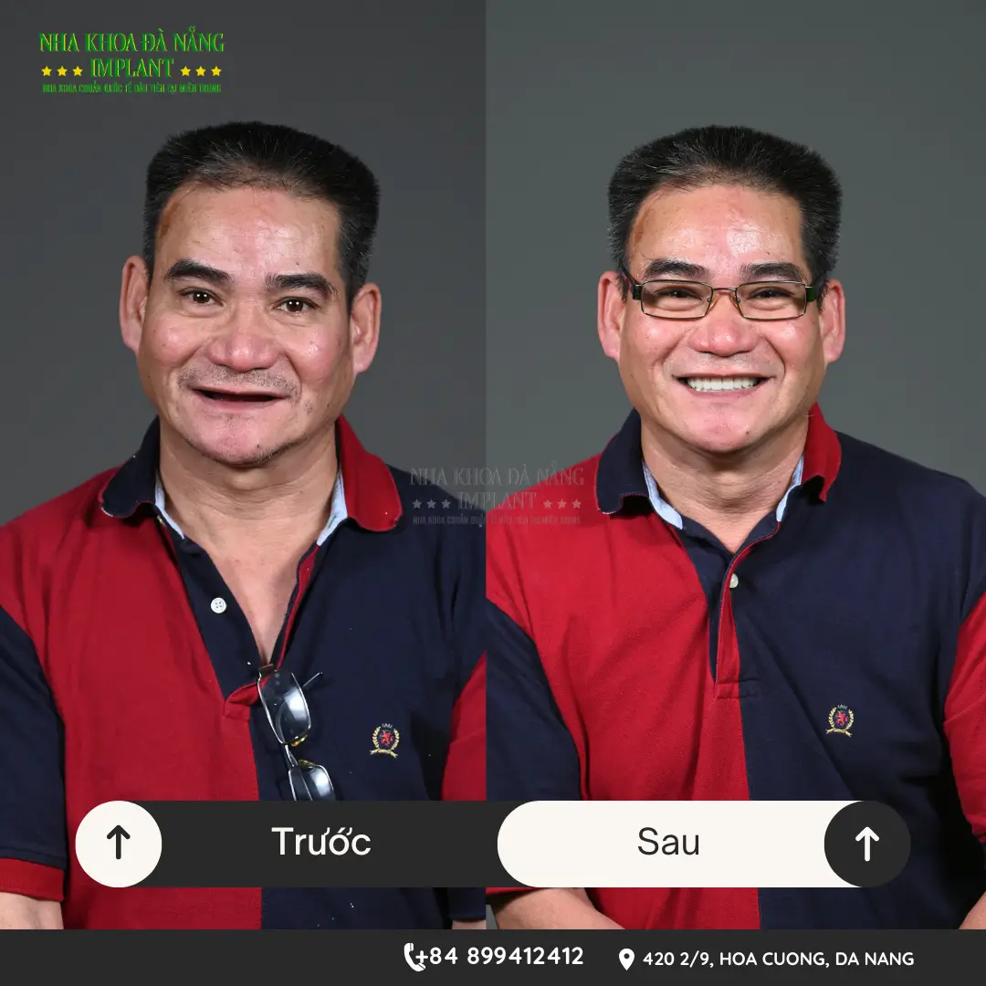 Răng Giả Tháo Lắp Dùng Được Bao Lâu? Bảng Giá & Mẹo Tăng Tuổi Thọ 16 Răng Giả Tháo Lắp Dùng Được Bao Lâu? Bảng Giá & Mẹo Tăng Tuổi Thọ