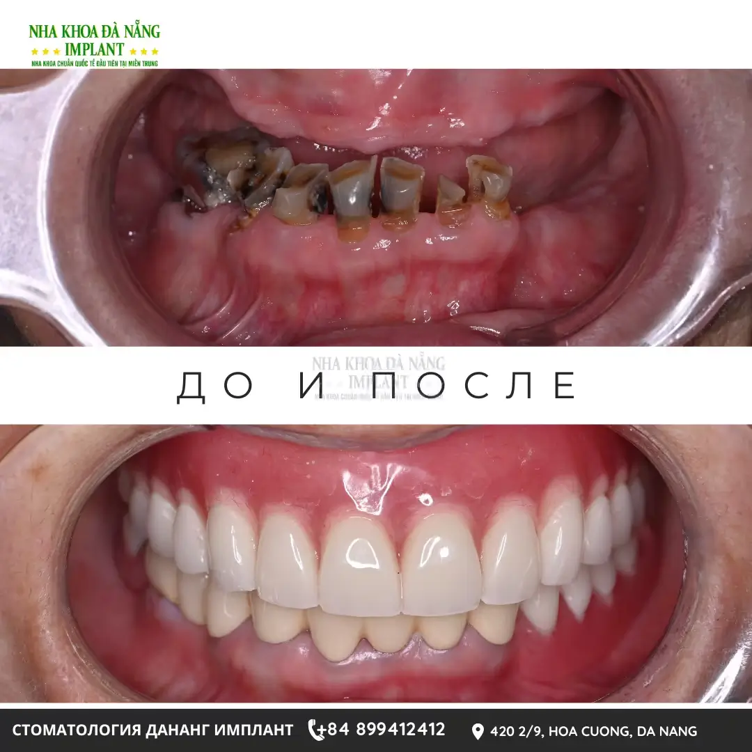 Фото до и после установки съёмных протезов