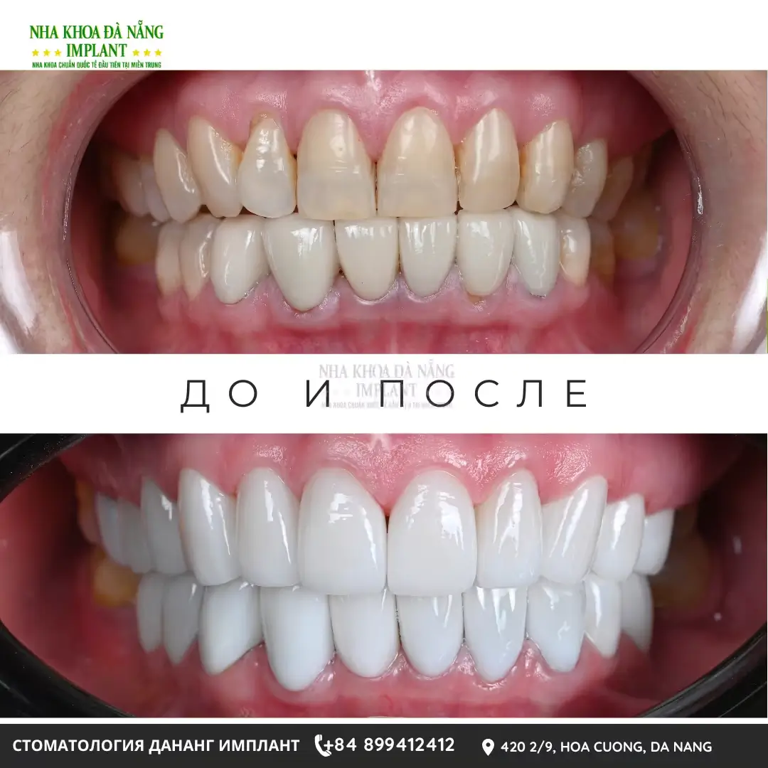 Керамическое протезирование в Da Nang Implant Dental Clinic
