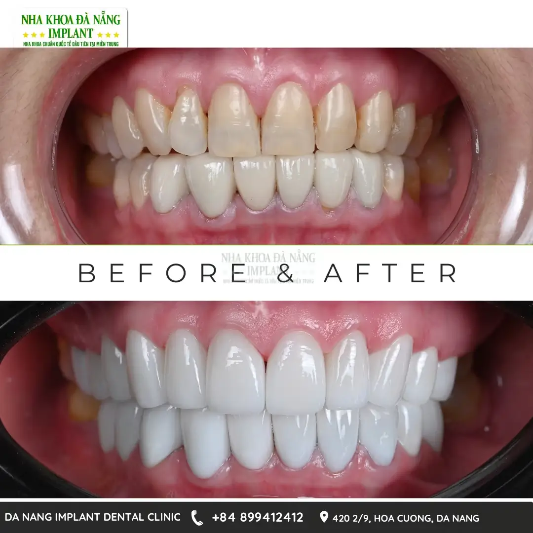 Top 7 mistakes that make dental crowns wear out quickly 10 Dental crown treatment at Da Nang Implant Dental Clinic
