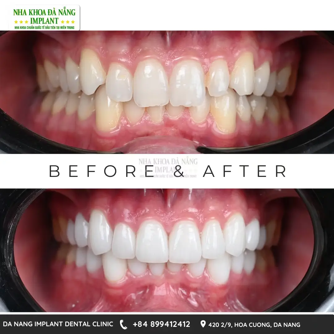 Why is it necessary to completely treat oral diseases before getting dental crowns?