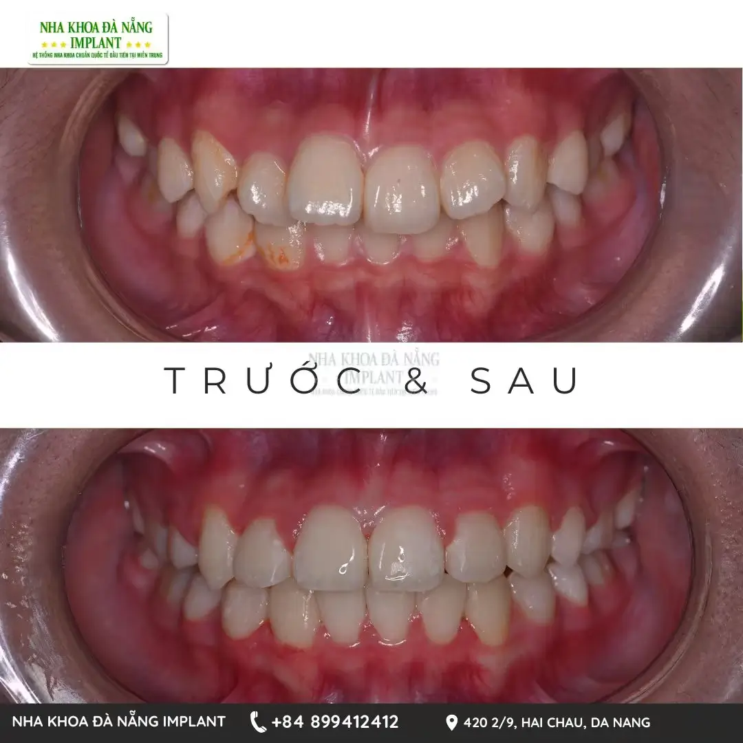 Niềng Răng Hỏng và Dấu Hiệu Nhận Biết và Giải Pháp Từ Nha Khoa Đà Nẵng Implant