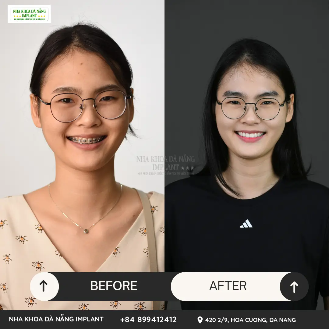 The patient experienced failed orthodontic treatment – Before and after braces at Da Nang Implant Dental Clinic