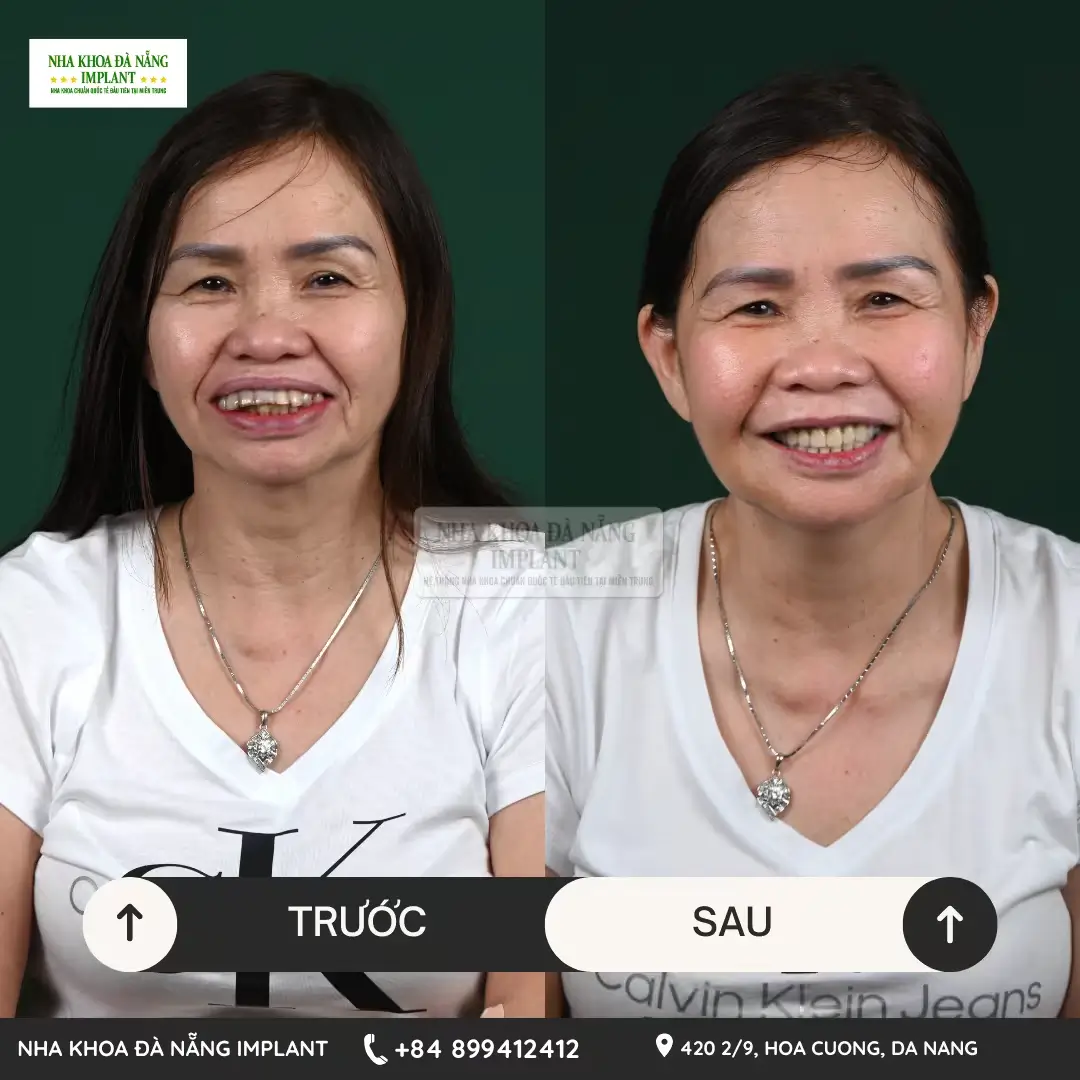 Trồng răng Implant chuẩn quốc tế – Tiết kiệm đến 70% chi phí cho Việt kiều tại Nha Khoa Đà Nẵng Implant 14 Khách hàng Huỳnh Thị An