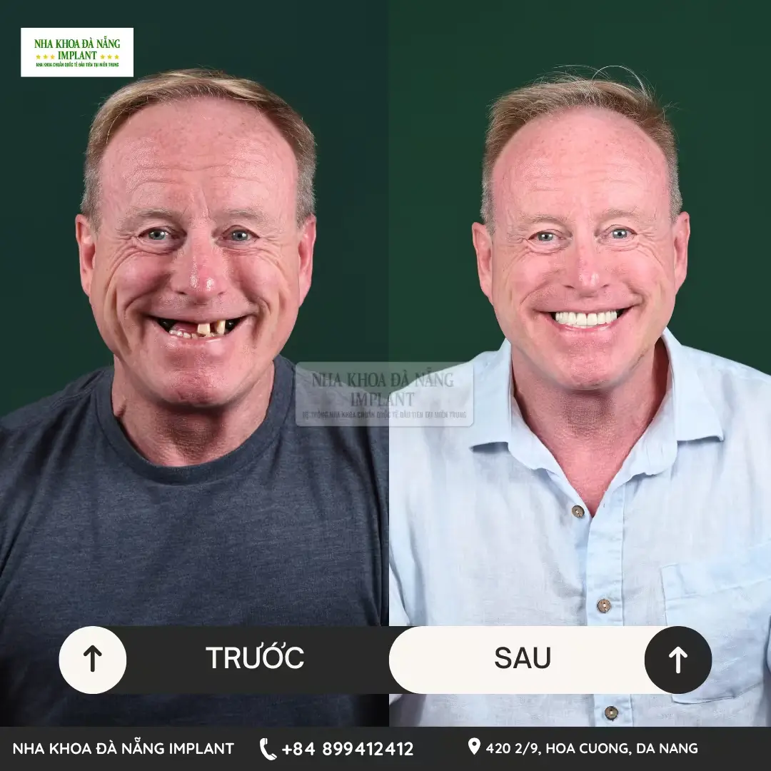 Cấy ghép Implant có đau không? Bác sĩ giải đáp 5 hiểu lầm phổ biến về Implant 14 Cấy ghép Implant tại Nha Khoa Đà Nẵng Implant