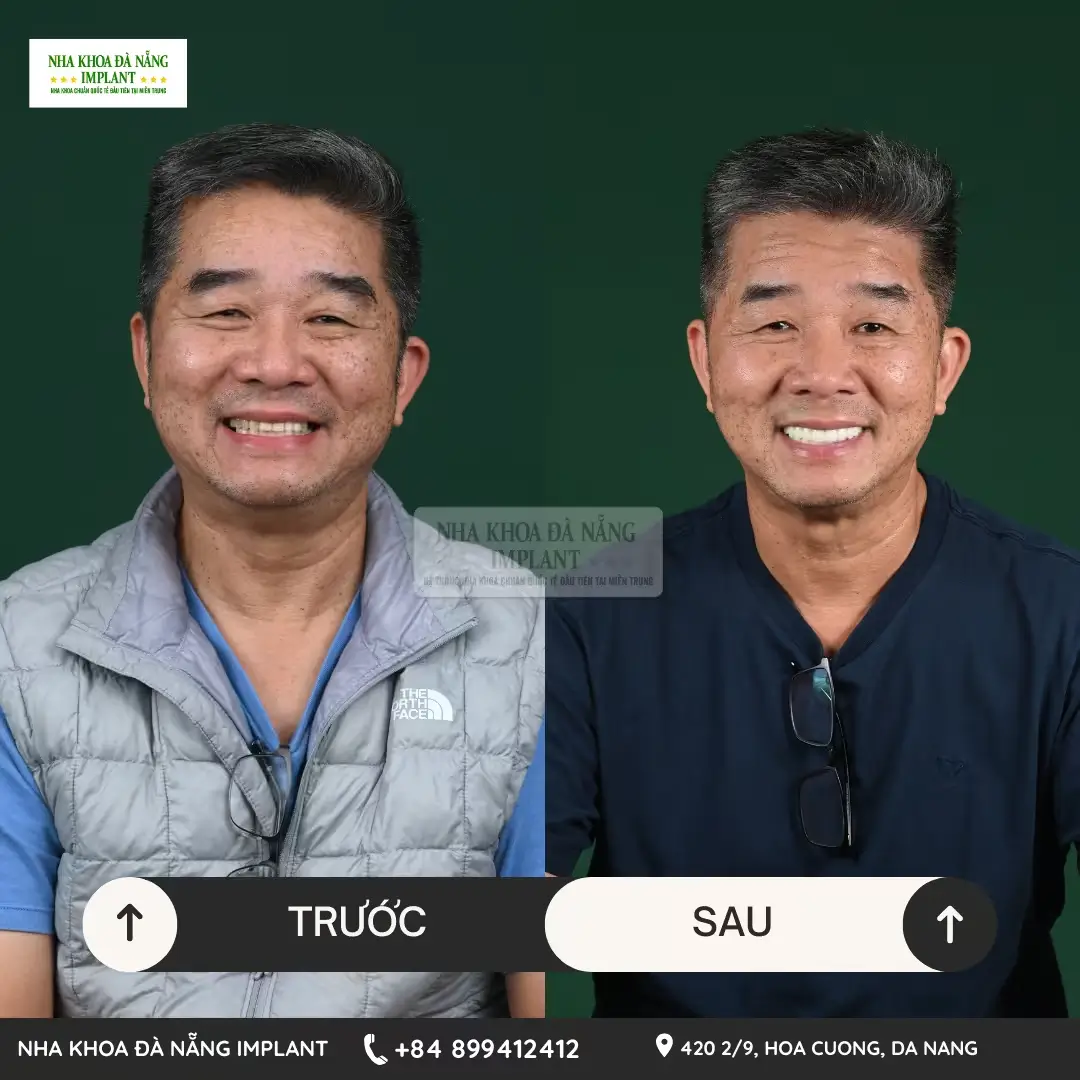 Trồng răng Implant chuẩn quốc tế – Tiết kiệm đến 70% chi phí cho Việt kiều tại Nha Khoa Đà Nẵng Implant 13 Khách hàng Larry Nguyễn
