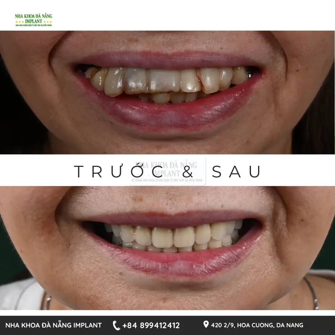 Bác sĩ Phan Văn Cường chia sẻ 10+ năm kinh nghiệm điều trị các ca cấy ghép Implant phức tạp