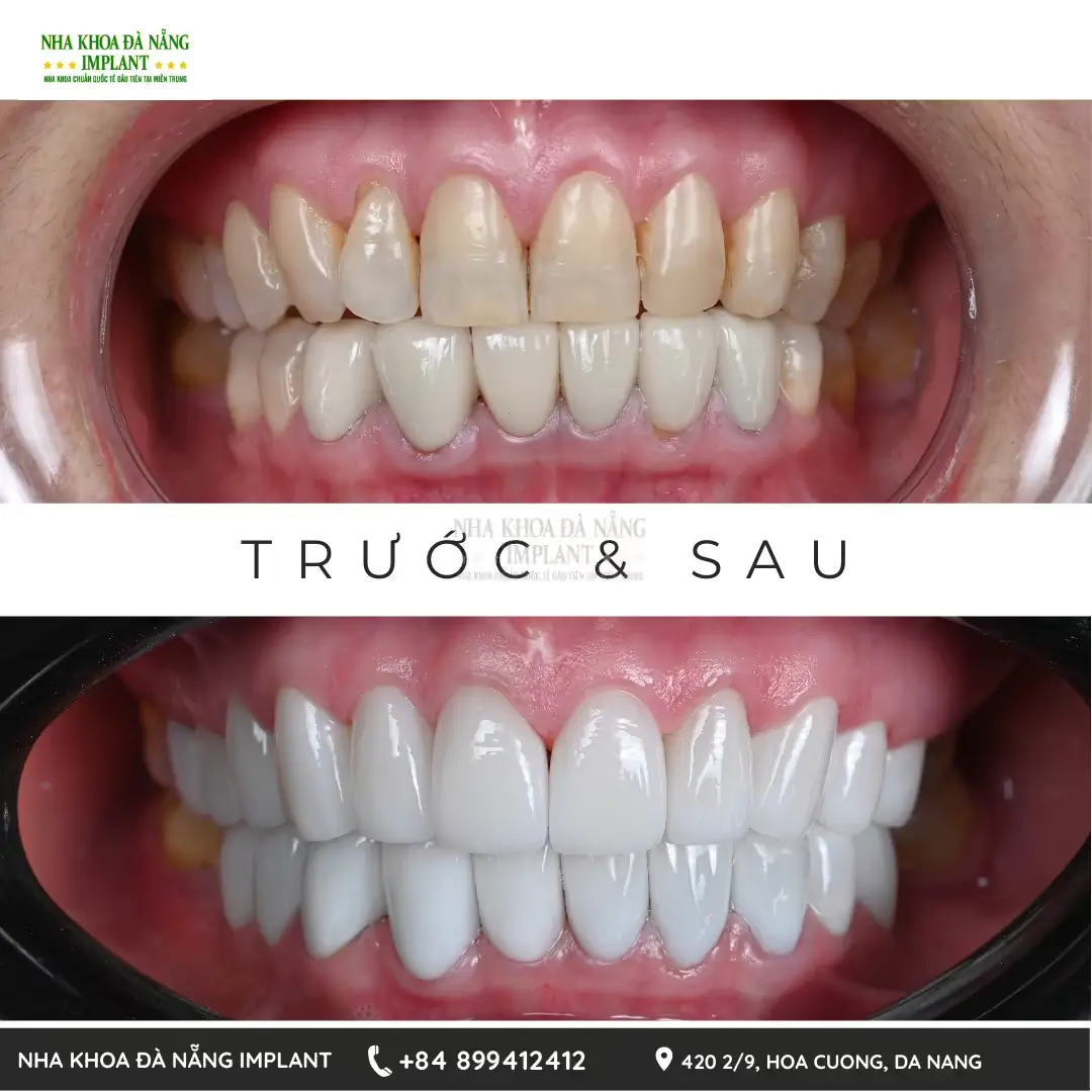 Bọc răng sứ tại Nha Khoa Đà Nẵng Implant
