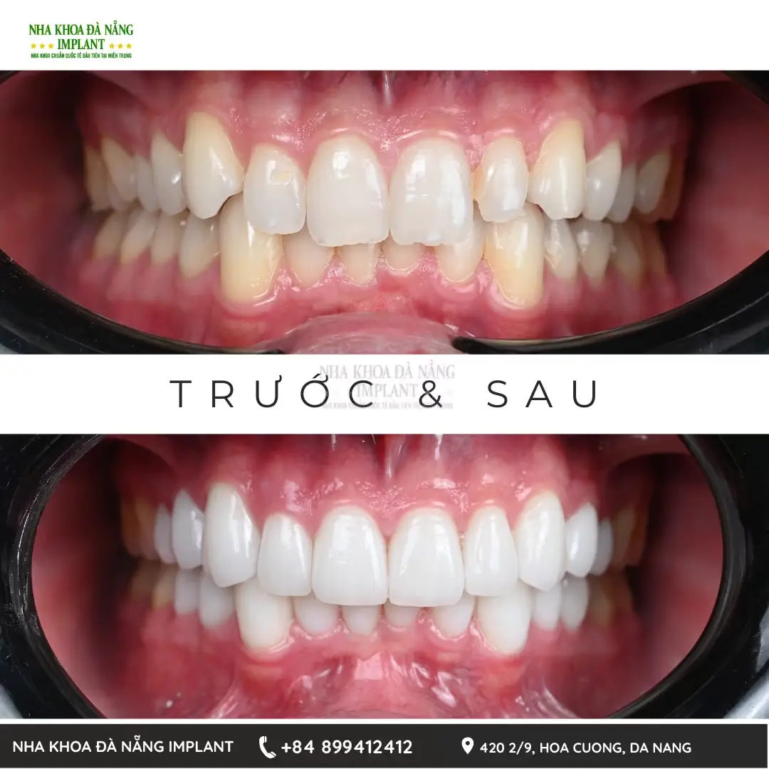 Tại sao phải điều trị dứt điểm các bệnh lý răng miệng trước khi bọc răng sứ?