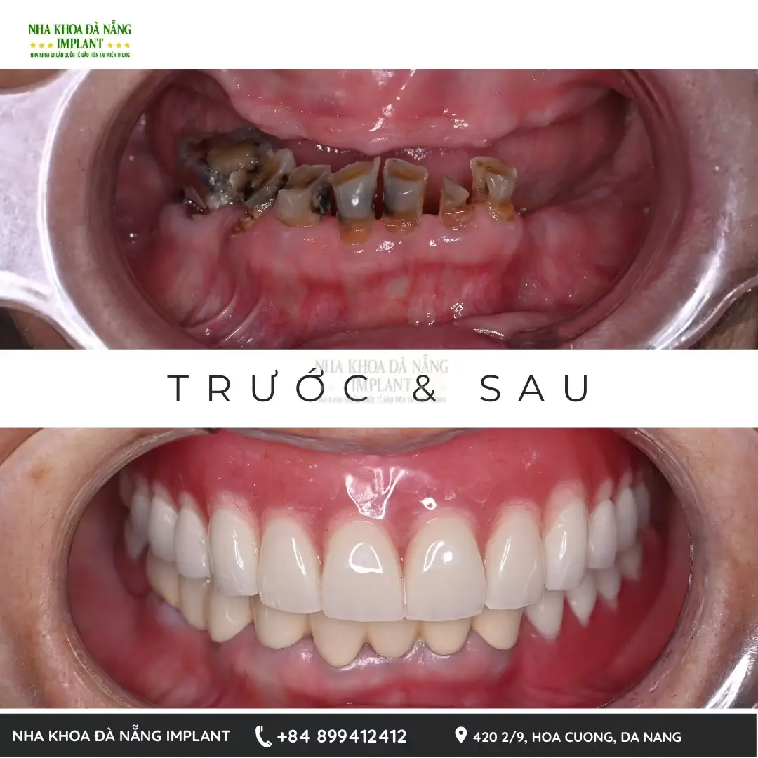 Răng Giả Tháo Lắp Dùng Được Bao Lâu? Bảng Giá & Mẹo Tăng Tuổi Thọ 14 Sự thay đổi trước và sau khi làm răng giả tháo lắp