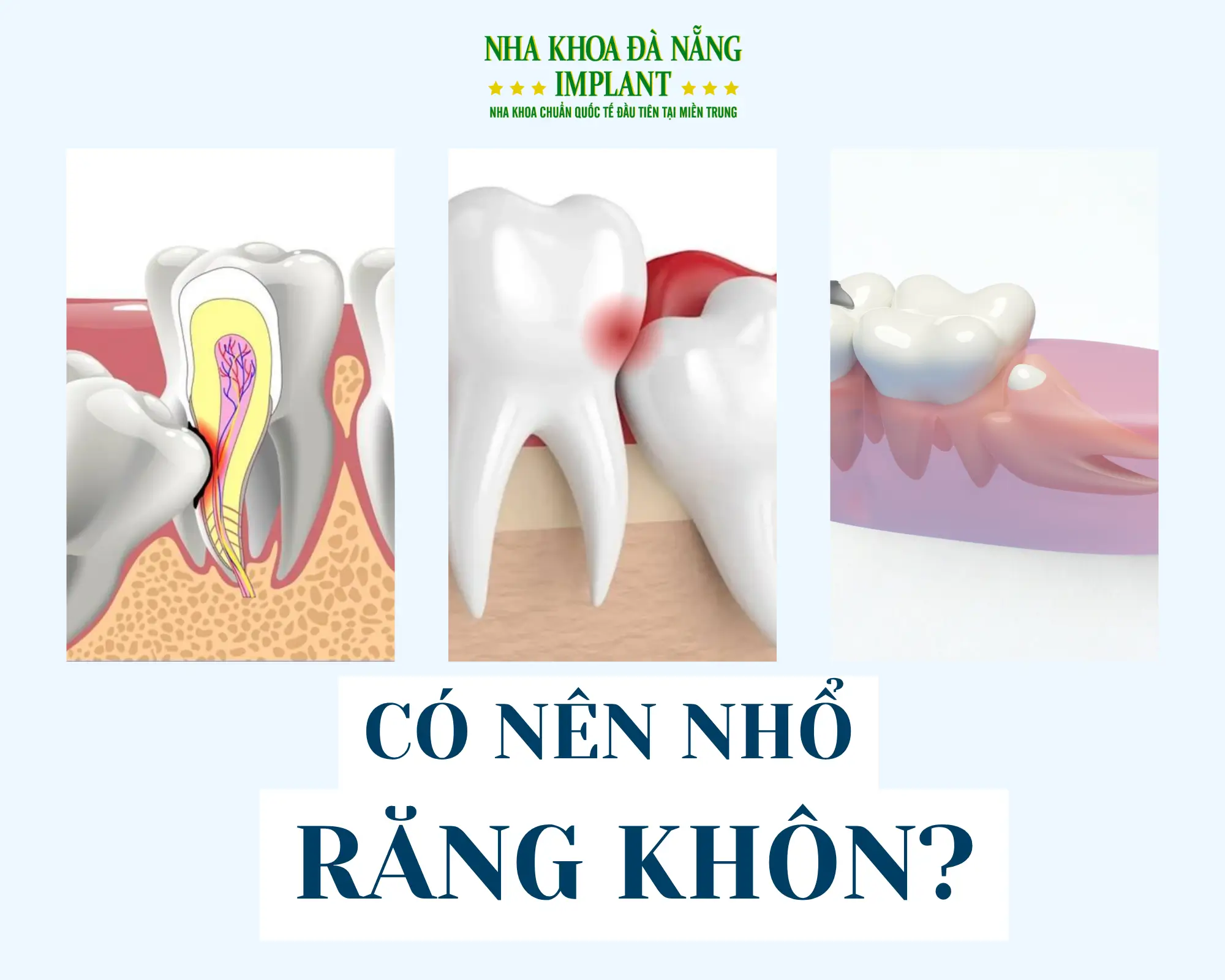 Các trường hợp nên nhổ răng khôn?