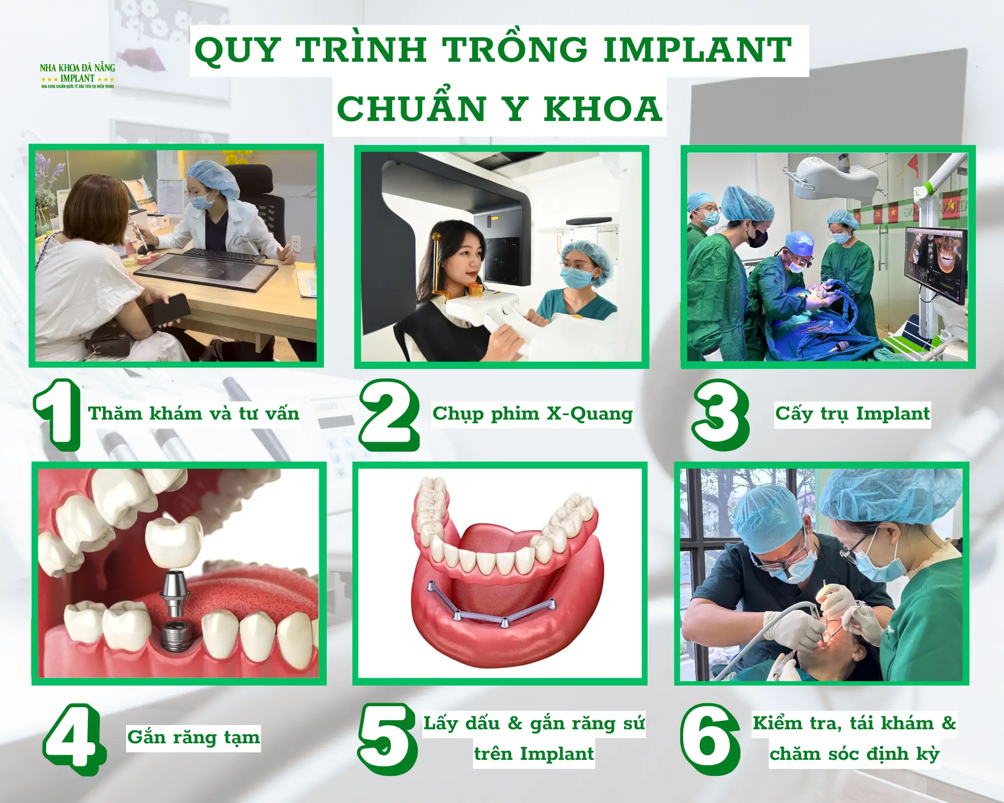 Trồng răng Implant chuẩn quốc tế – Tiết kiệm đến 70% chi phí cho Việt kiều tại Nha Khoa Đà Nẵng Implant 12 Quy trình cấy ghép Implant tại Nha Khoa Đà Nẵng Implant