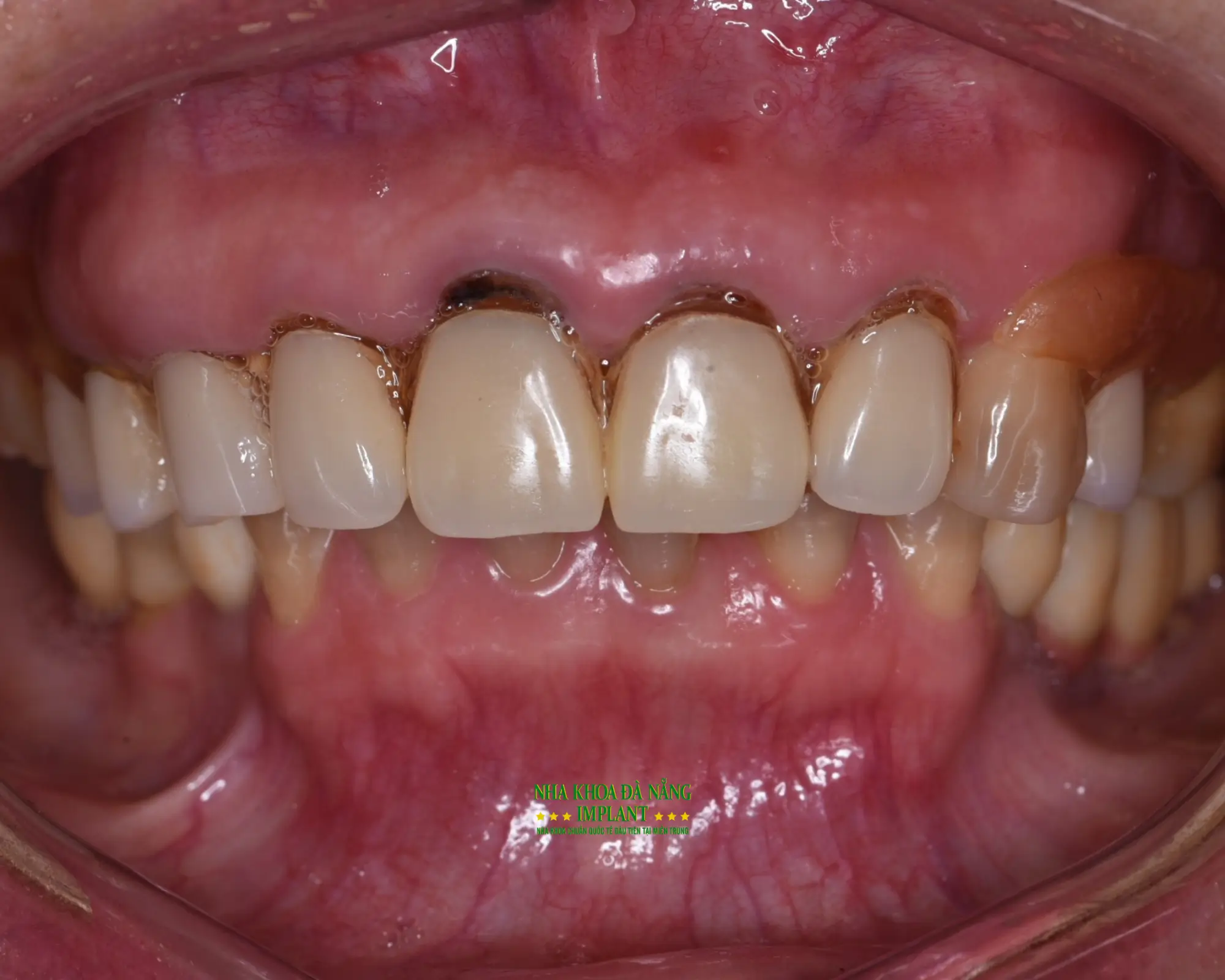 Top 7 mistakes that make dental crowns wear out quickly 9 Reasons why porcelain crowns deteriorate quickly