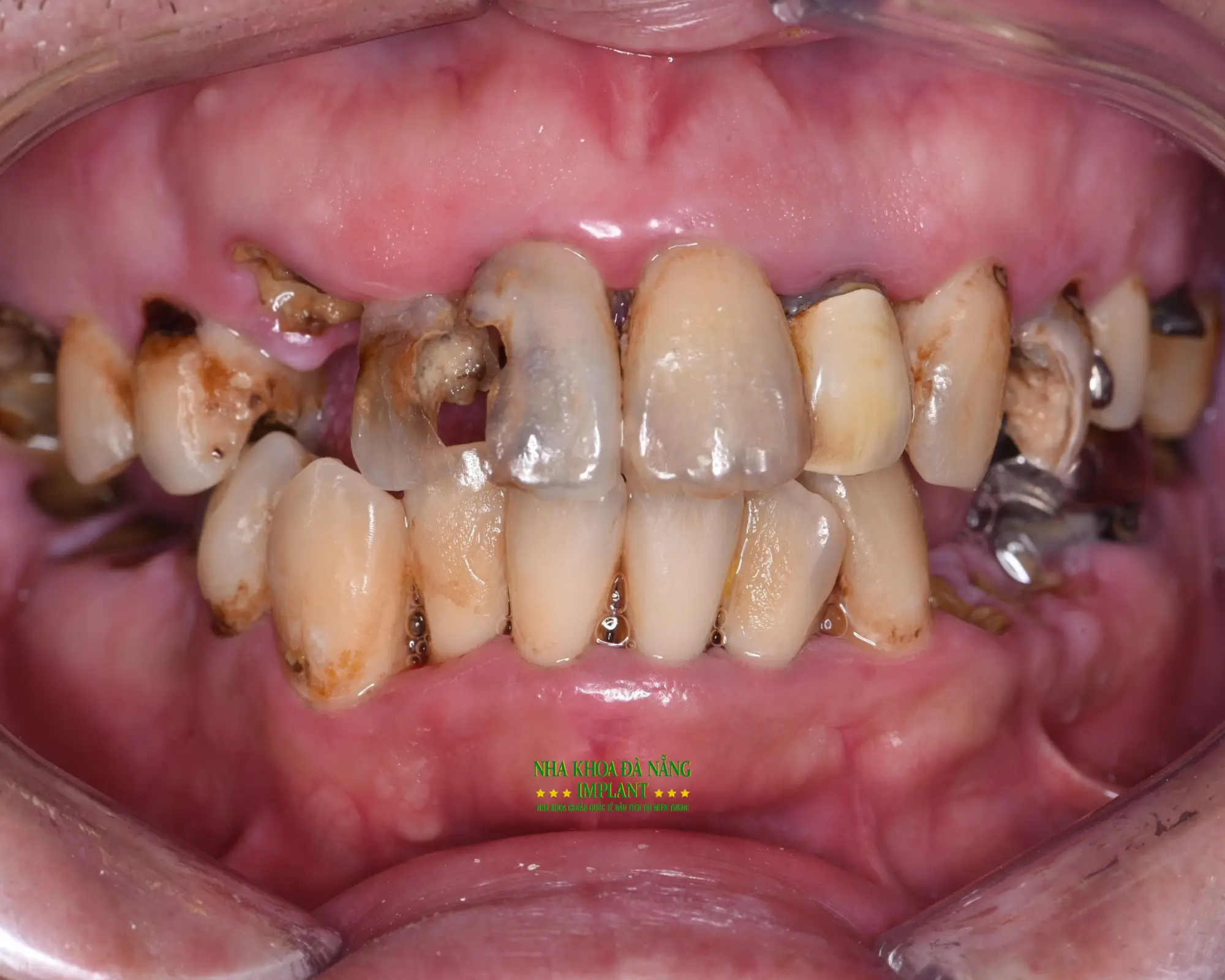 Top 7 mistakes that make dental crowns wear out quickly 13 Top 7 mistakes that make dental crowns wear out quickly