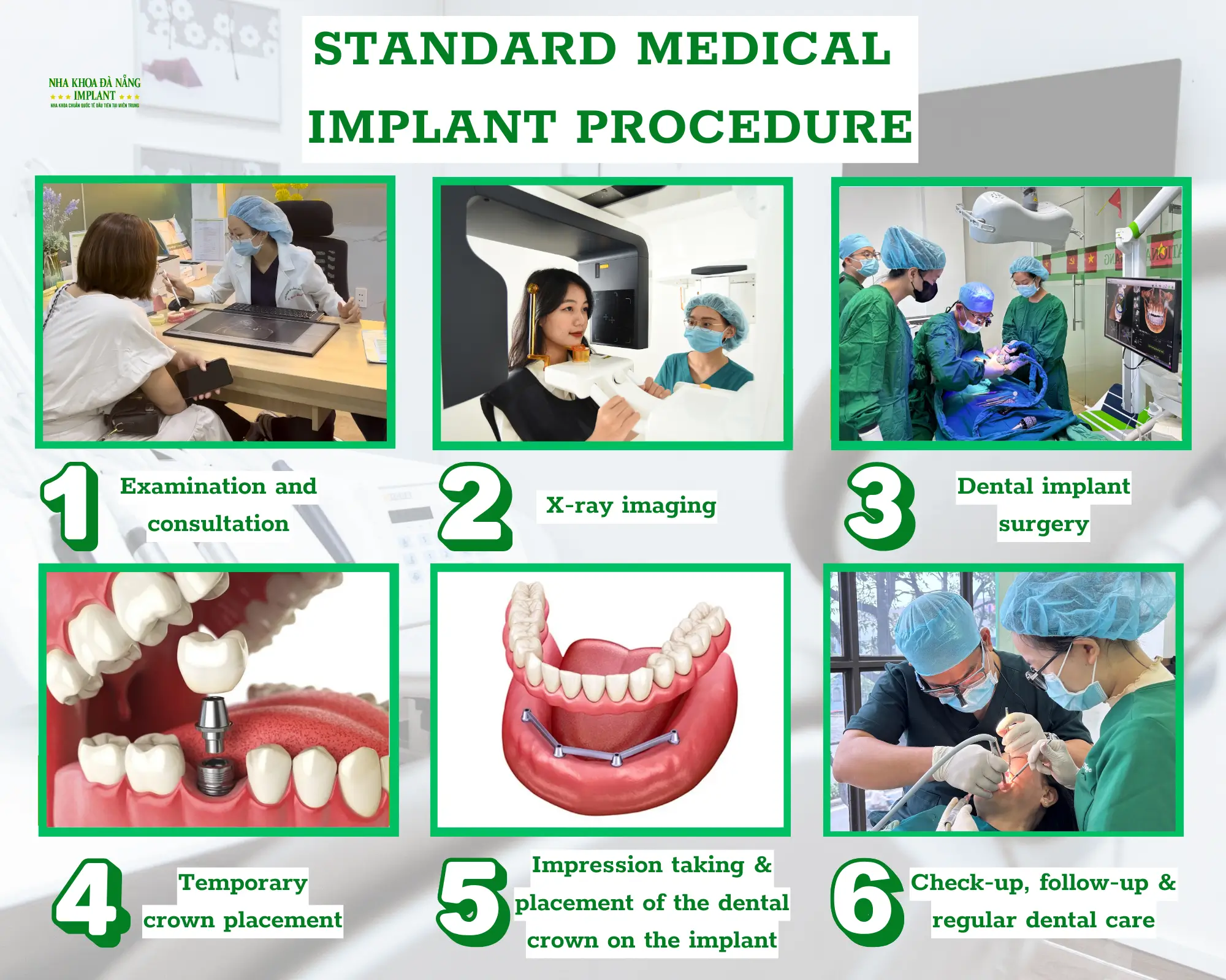 International standard dental implant – Save up to 70% of costs for overseas Vietnamese at Da Nang Implant Dental Clinic 12 Implant Procedure at Da Nang Implant Dental Clinic