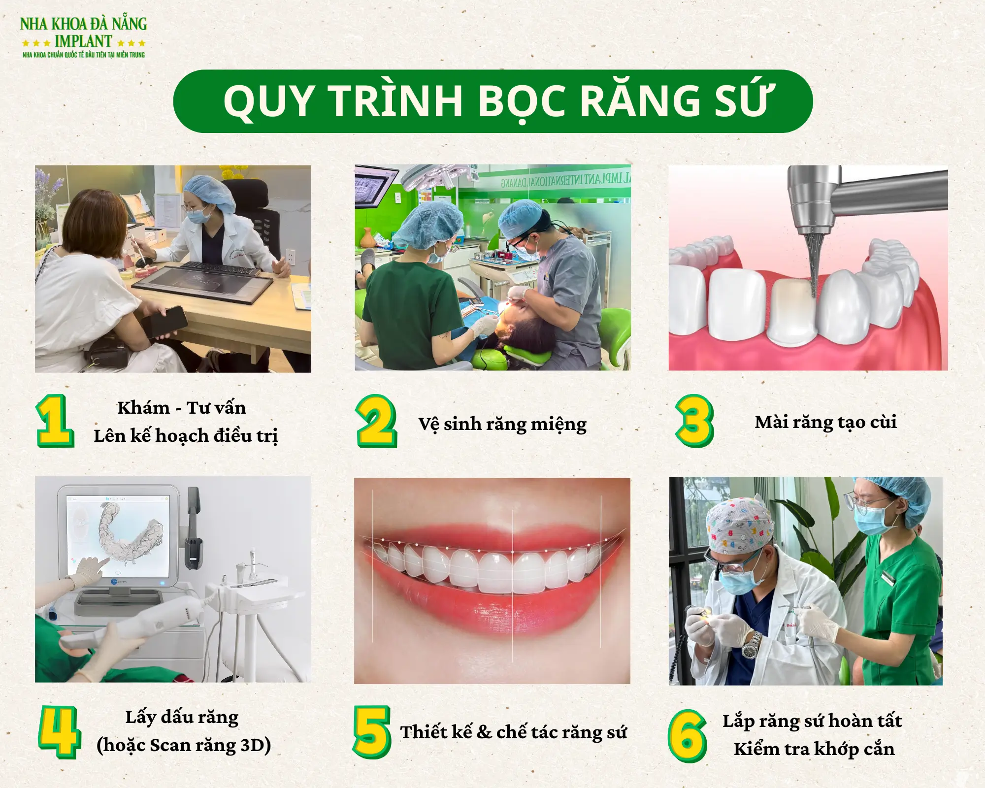 Quy trình bọc răng sứ tại Nha Khoa Đà Nẵng Implant
