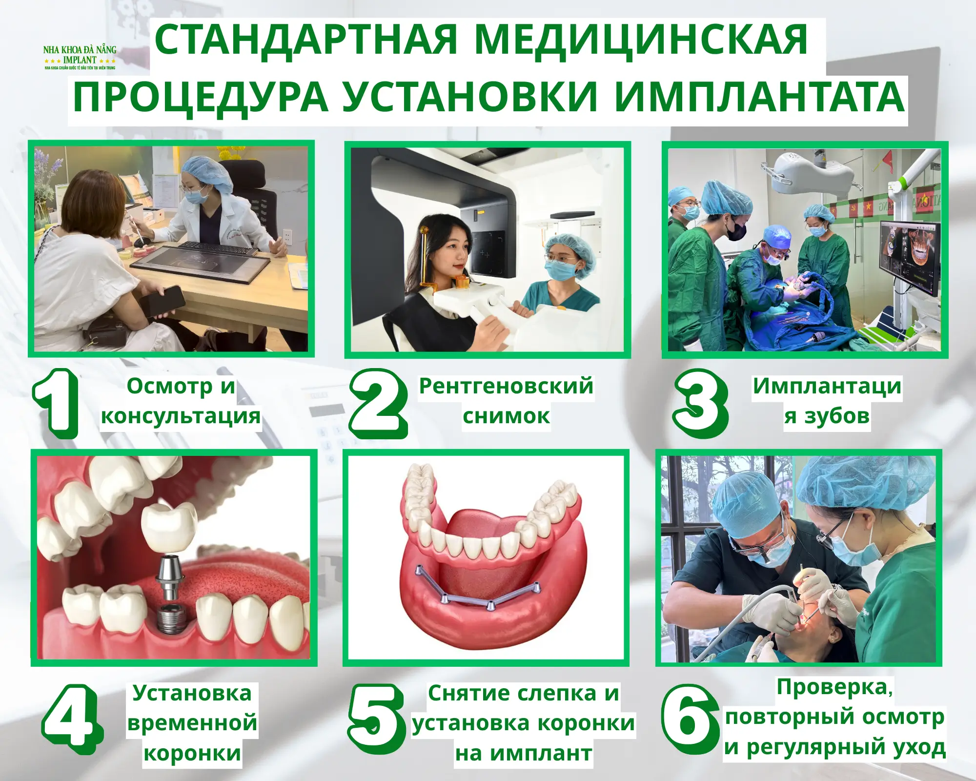 Имплантация зубов – до 70% экономии для вьетнамцев за границей 12 Процедура имплантации в Da Nang Implant Dental Clinic
