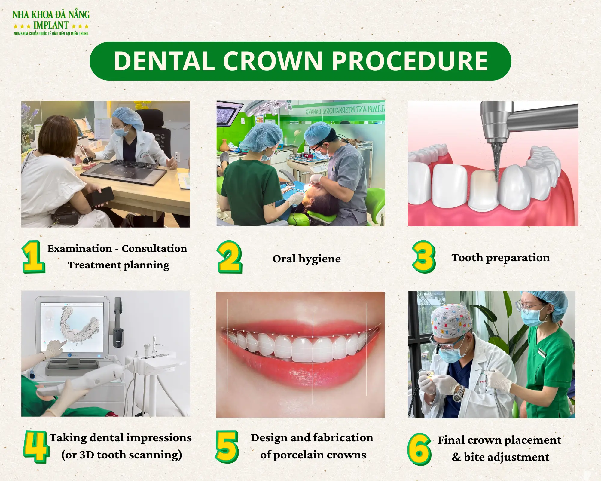 Top 7 mistakes that make dental crowns wear out quickly 16 Dental Crown Procedure at Da Nang Implant Dental Clinic