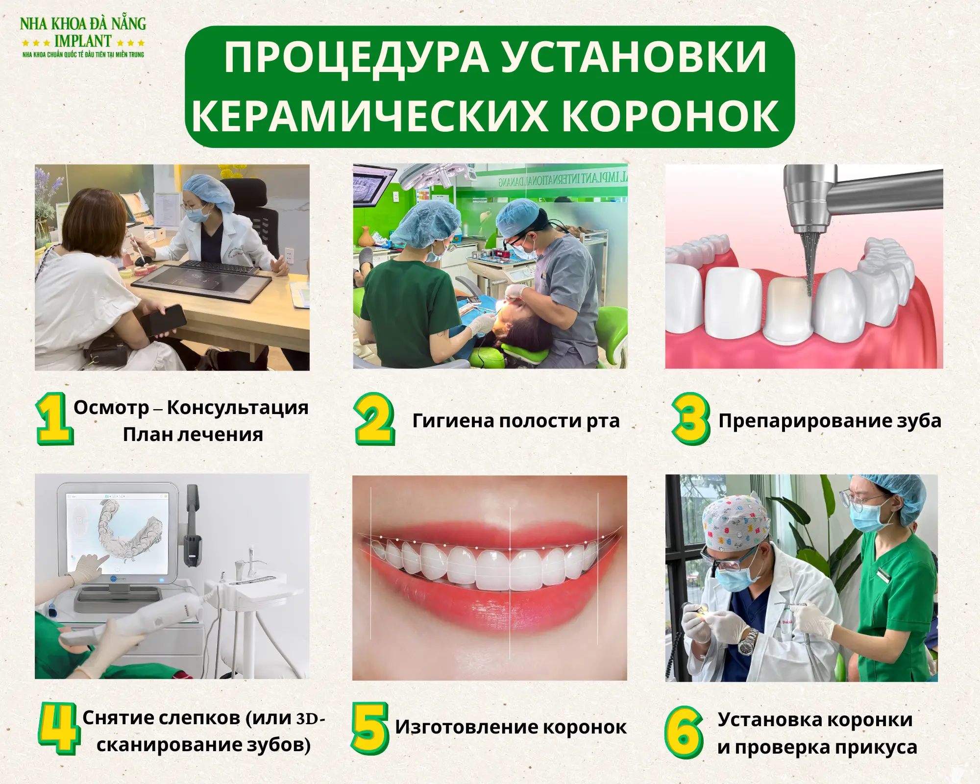 Процедура установки керамических коронок в Da Nang Implant Dental Clinic