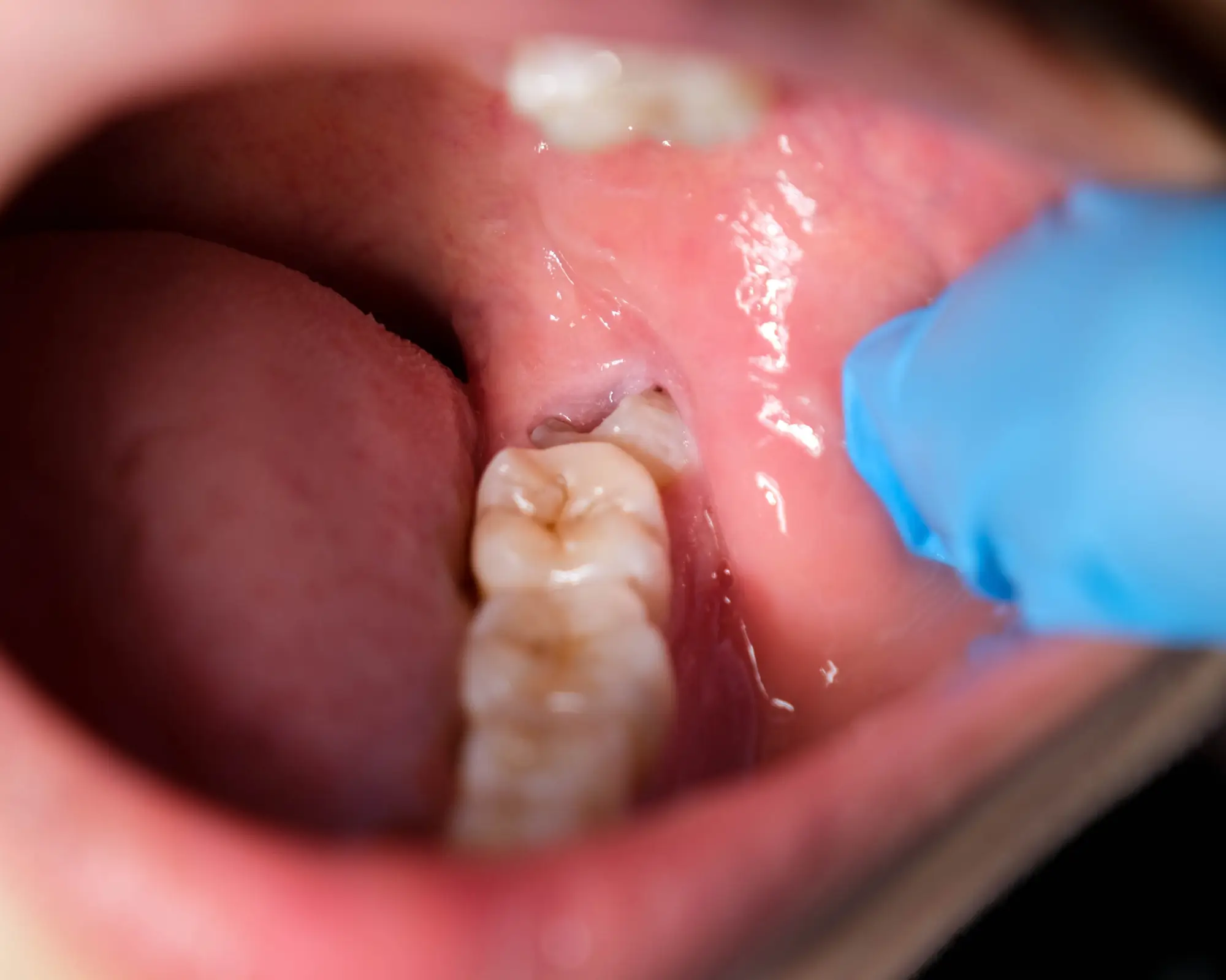 What happens after wisdom tooth extraction – Recover quickly with this simple tip
