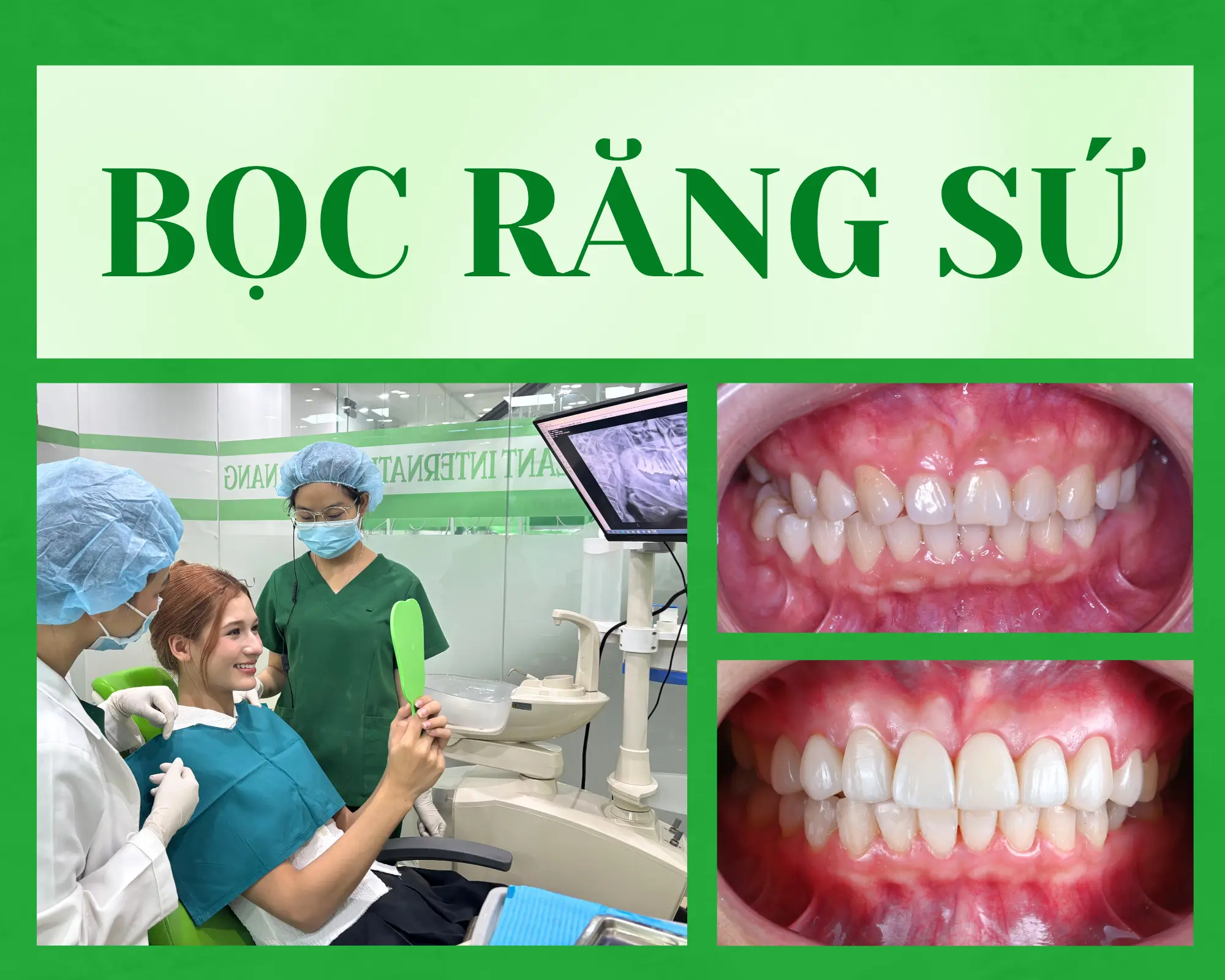 Tại sao phải điều trị dứt điểm các bệnh lý răng miệng trước khi bọc răng sứ?