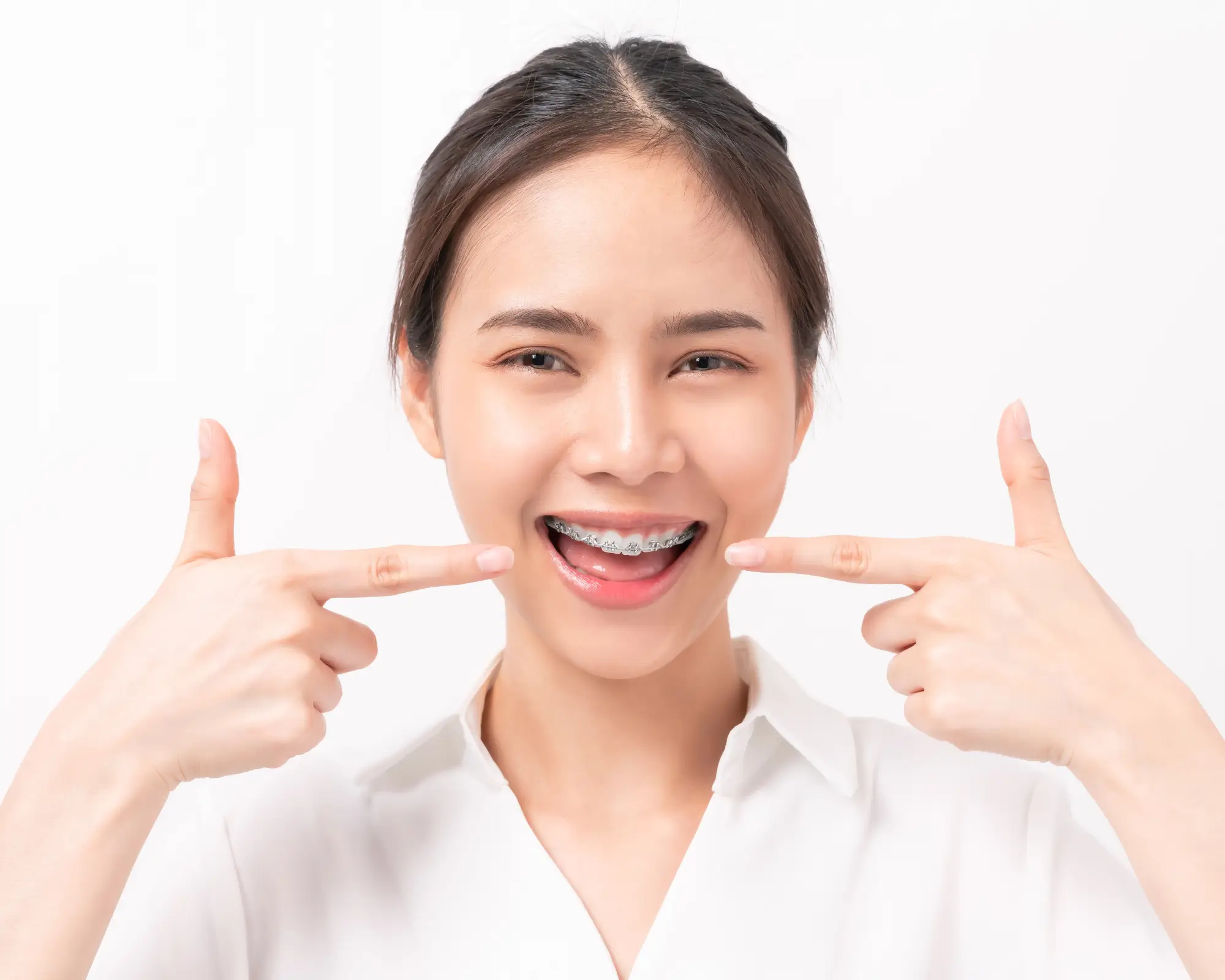 Cách chăm sóc răng sau khi niềng răng để không bị chạy lại – Hướng dẫn chi tiết từ Nha Khoa Đà Nẵng Implant