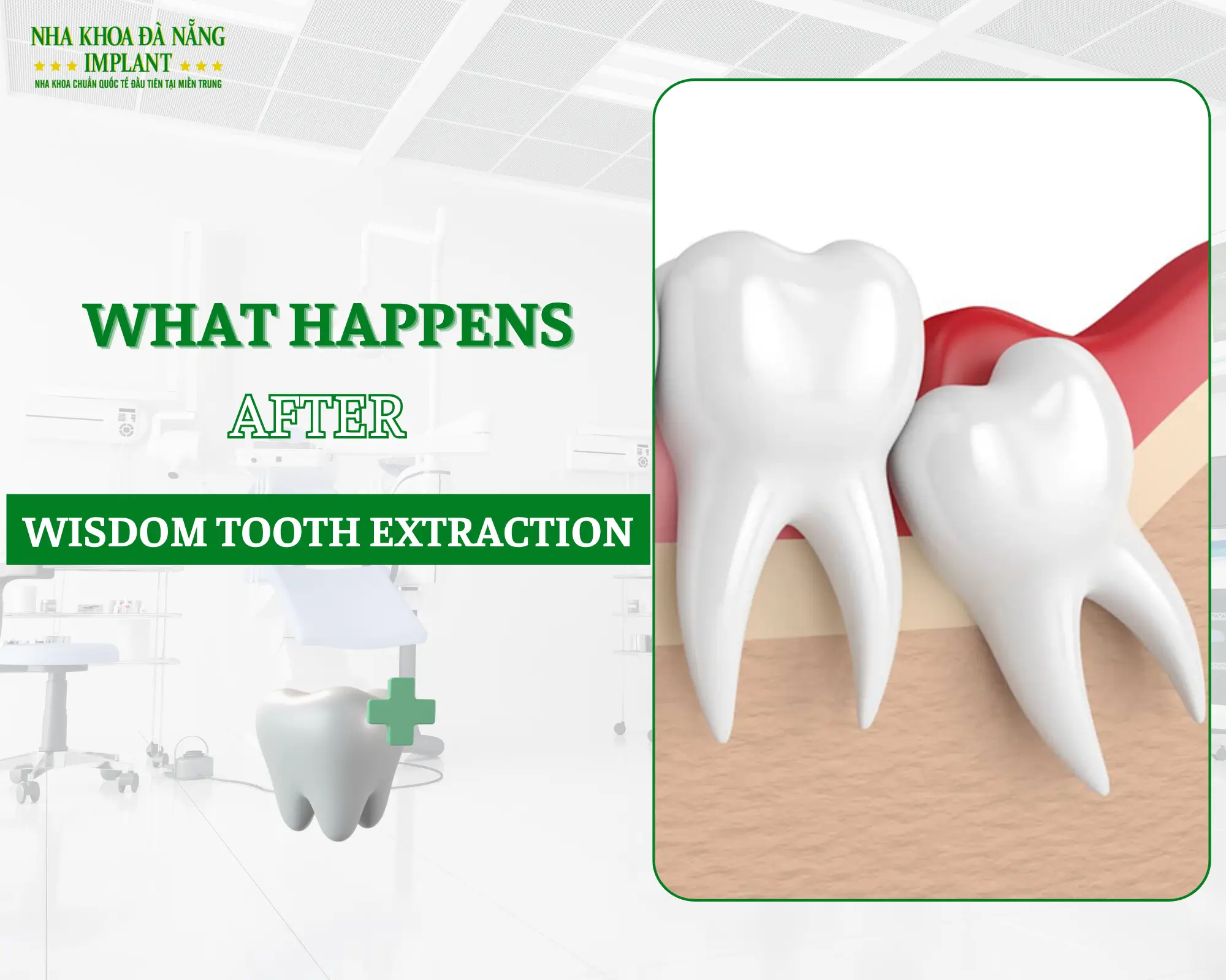 What happens after wisdom tooth extraction?